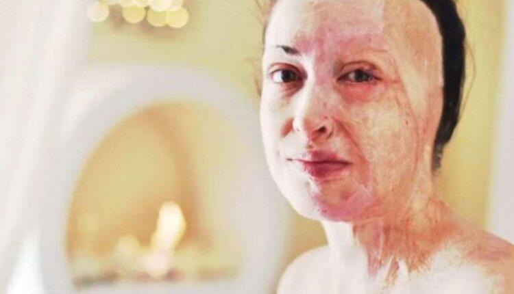 H Ιωάννα Παλιοσπύρου έδειξε το πρόσωπό της και περιέγραψε τις δραματικές στιγμές της επίθεσης με βιτριόλι
