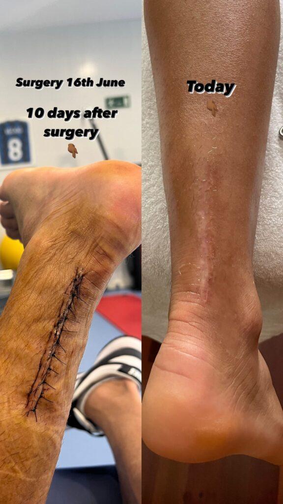 Ο Πάολο Φερνάντες «δείχνει» πώς ήταν το πόδι του ακριβώς μετά την εγχείρηση και πώς σήμερα (ΦΩΤΟ)