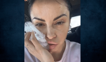 Δήμητρα Αλεξανδράκη: Ατύχημα στον δρόμο για το μοντέλo – «Προσγειώθηκε η μπάρα στο κεφάλι μου»